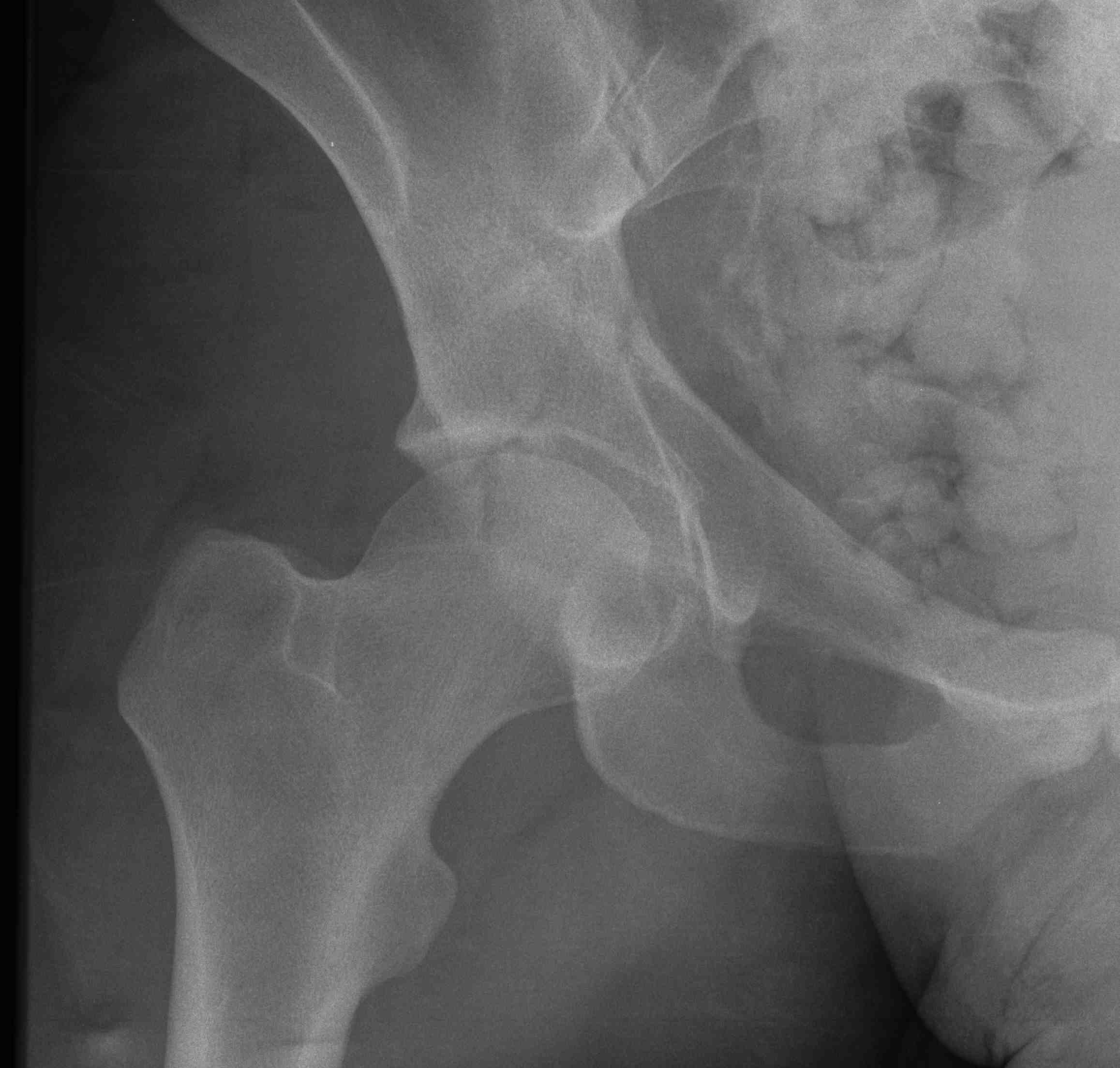 Posterior Column Fracture 1